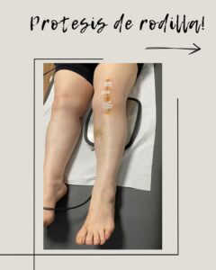 protesis de rodilla recuperacion - indiba - fisioterapia asturias